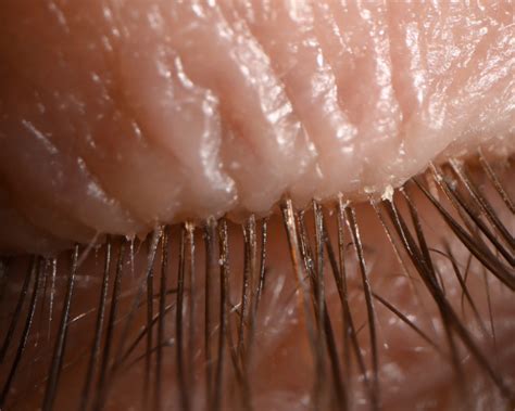  Eyelash Mite! A Tiny Parasite with an Enormous Impact on Human Health